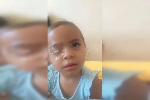 Criança gruda olho com Super Bonder e precisa de cirurgia
