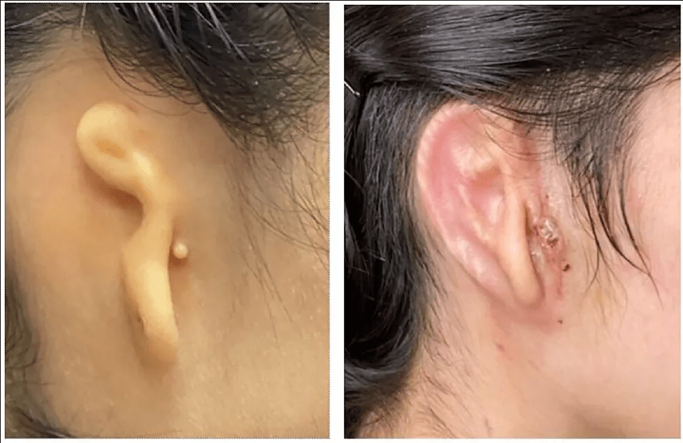 Inédito! Cientistas implantam orelha usando impressão 3D