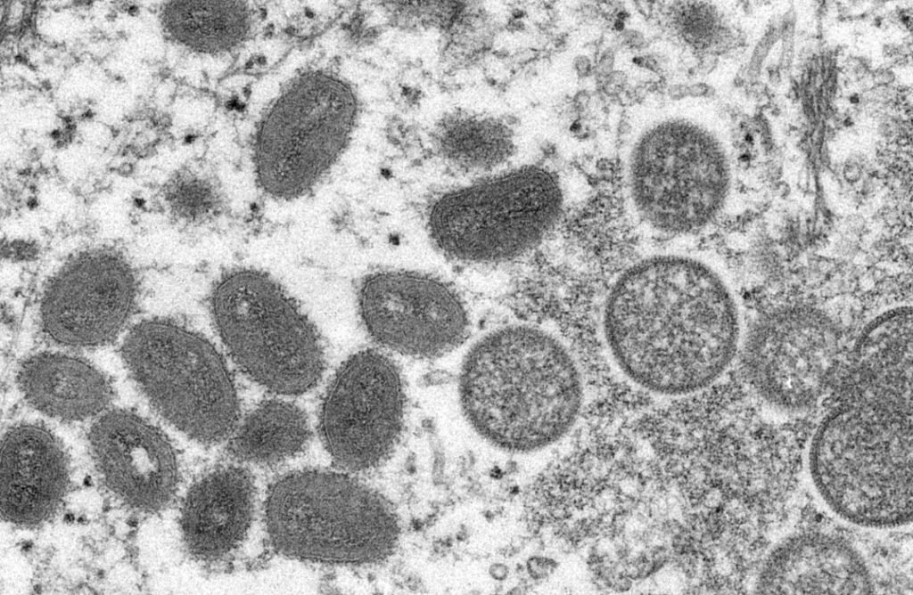Pesquisa identifica dois novos sintomas da varíola dos macacos