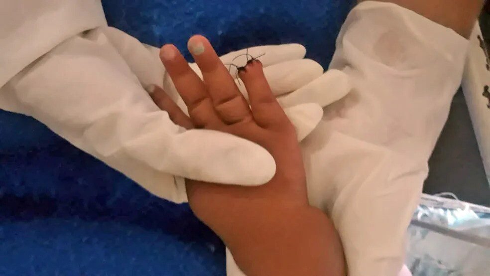 Bebê tem dedo amputado acidentalmente por enfermeira